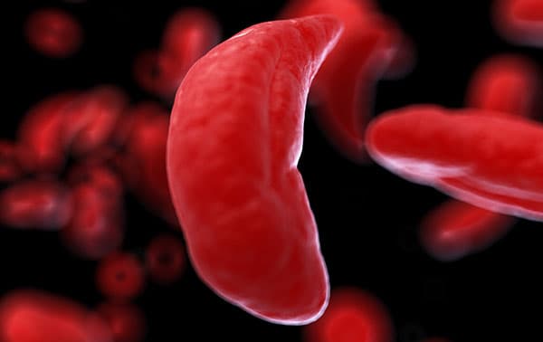 Computer generated Sickle Cell blood cell illustration.