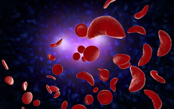 Sickle Cell Disease Computer Illustration