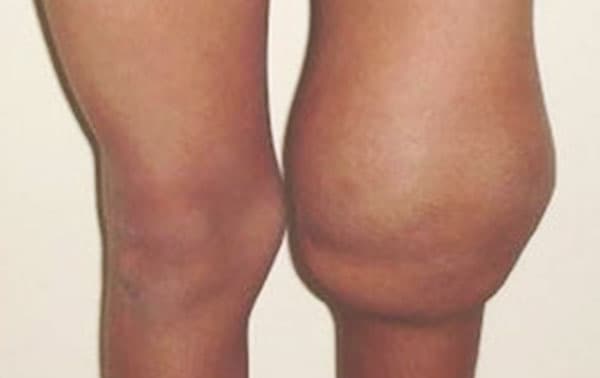 Example of TThrombo-inflammatory mechanism of joint damage in hemophilia