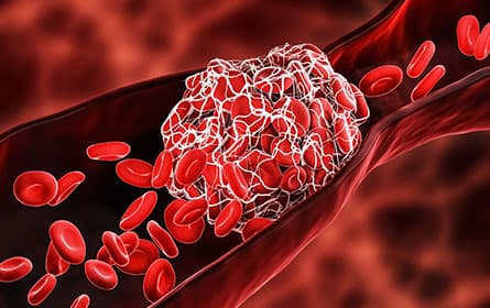 Computer illustrations of a blood clot forming.