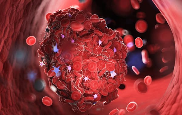 3d rendered medically accurate illustration of a blood clot
