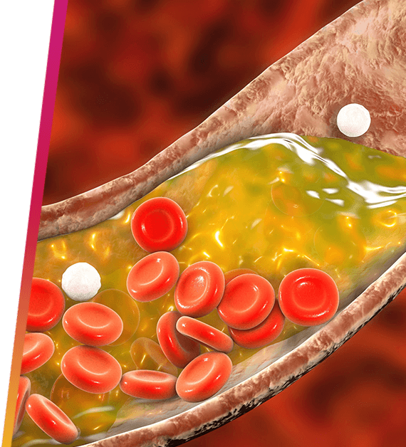 Computer generated 3D illustration of plaque in an artery.